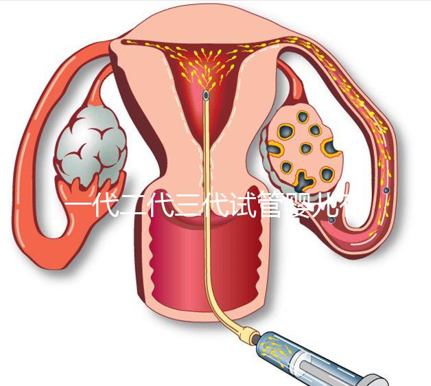 一代二代三代試管嬰兒有什么區別