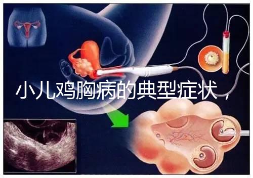 小兒雞胸病的典型癥狀，早發(fā)現早治療很重要！